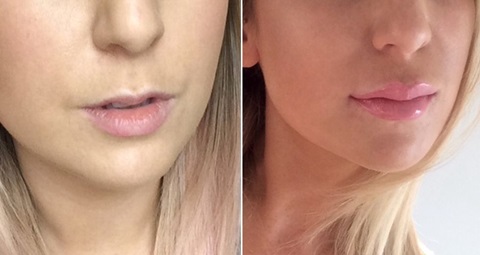 Dermal filler before and after