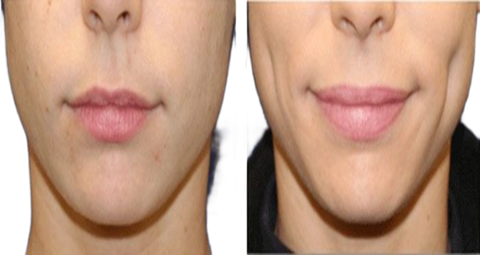 Dimple creation before and after