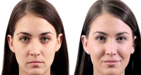 Fillers injections before and after