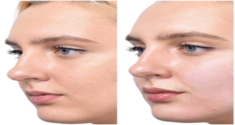 Fillers injections before and after