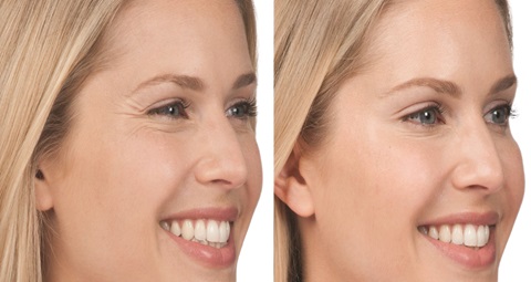 Fillers injections before and after