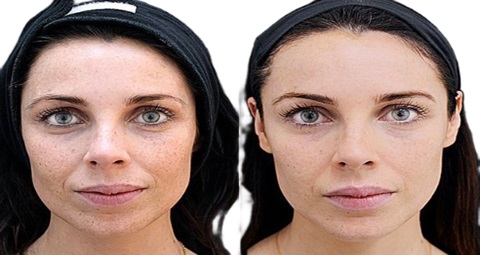 Fillers injections before and after