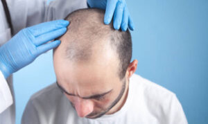 Hair transplant Cost in Dubai