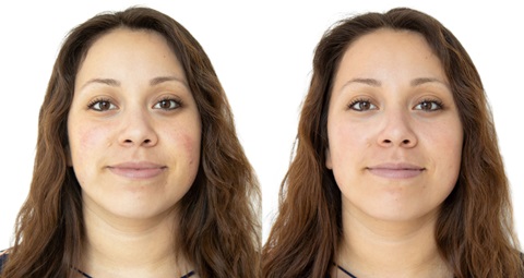 HydraFacial Before and After