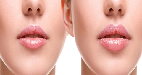 Lip Fillers Before and After