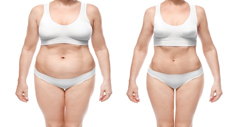 Liposuction before and after