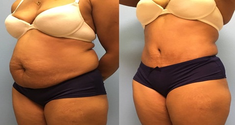 Liposuction before and after