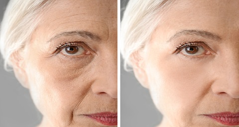 Botox before and after