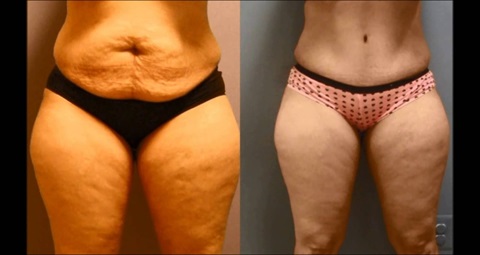 Tummy tuck before and after