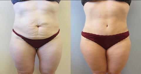 Tummy tuck before and after