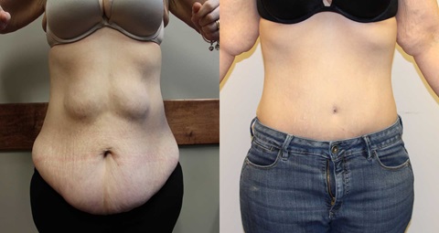 Tummy tuck before and after