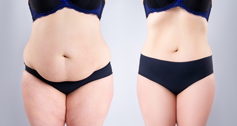 Tummy tuck before and after