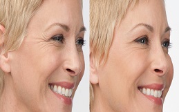 Botox injection before and after