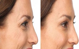 Botox injection before and after