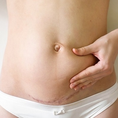 Circumferential Abdominoplasty