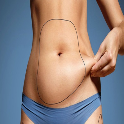 Circumferential Abdominoplasty