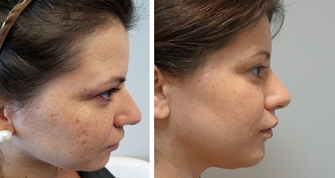 Fractional Laser CO2 before and after