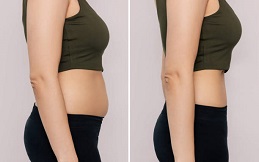 Fat Melting Injections before and after