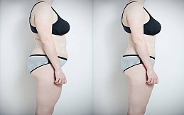 Fat Melting Injections before and after