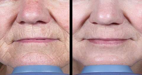 Fractional Laser CO2 before and after