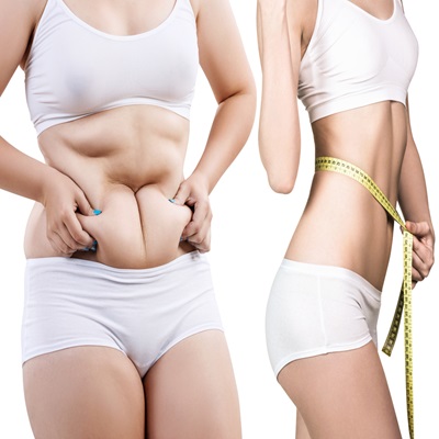 Laser Liposuction in Dubai