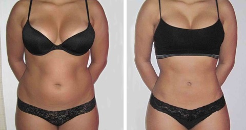 Laser Liposuction Before and After