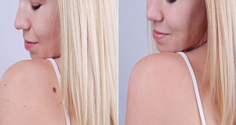 Birthmark removal before and after