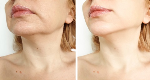 Morpheus 8 before and after