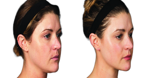 Morpheus 8 before and after
