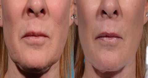 Morpheus 8 before and after