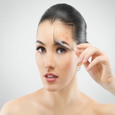 Pimples treatment in Dubai