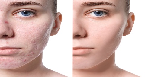Pimples Treatment Before and After