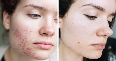 Pimples Treatment Before and After