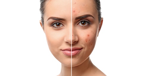 Pimples Treatment Before and After