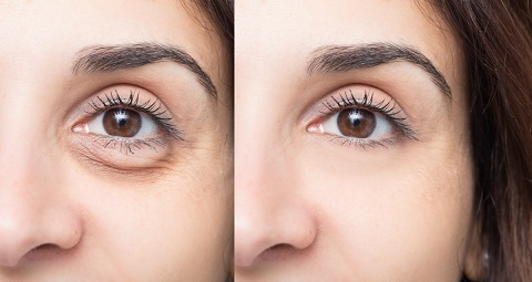 Dark Circle Treatment before and after