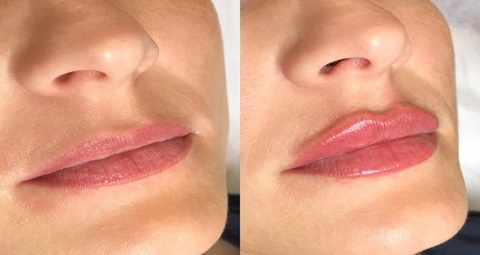 Russian Lip Fillers Before and After