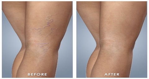 Varicose veins before and after