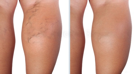 Varicose veins before and after