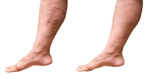 Varicose veins before and after