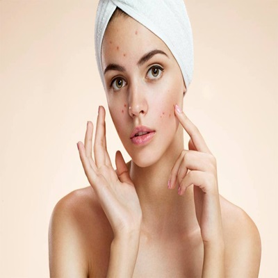 Pimples treatment in Dubai