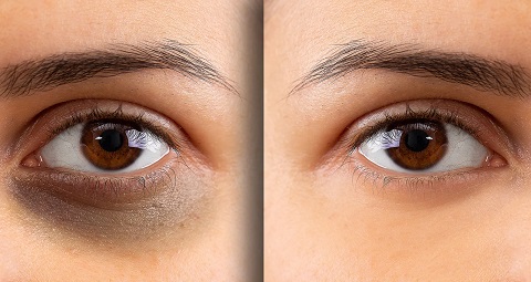 Dark Circle Treatment before and after