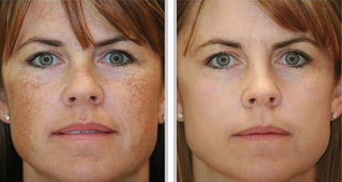Birthmark removal before and after
