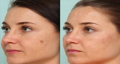 Birthmark removal before and after