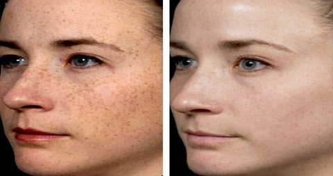 Birthmark removal before and after