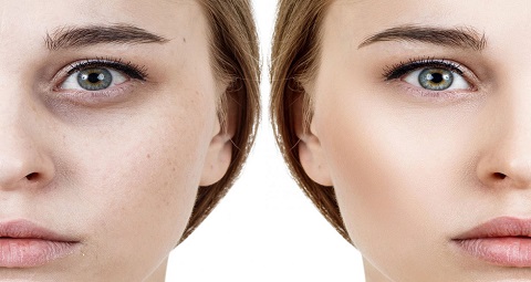 Dark Circle Treatment before and after
