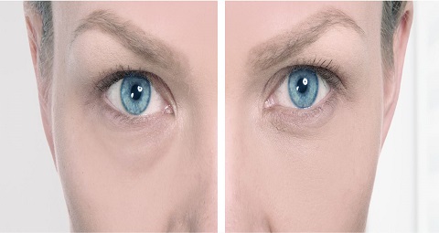 Dark Circle Treatment before and after