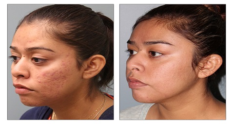 Fractional Laser CO2 before and after