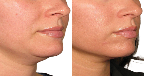 Mesotherapy before and after
