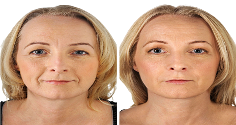 Mesotherapy before and after