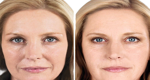 Mesotherapy before and after